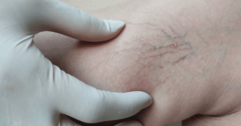 Close-up of spider veins.