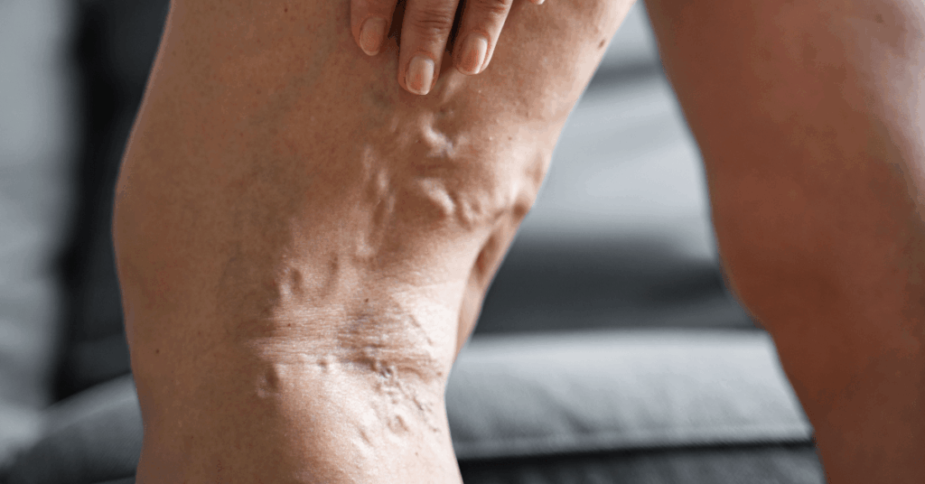 Leg with varicose veins