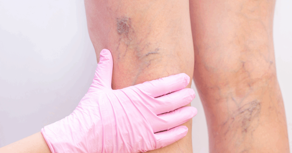 varicose vein treatment