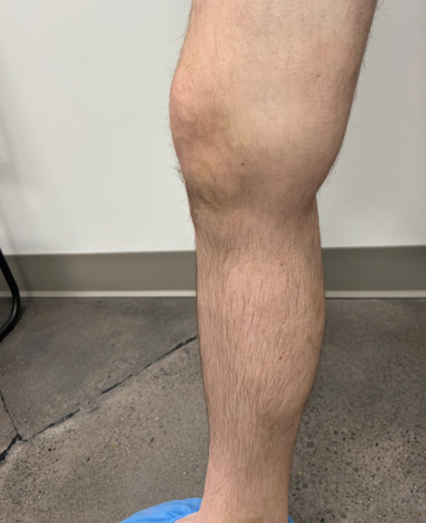 After Image: Spider Vein Treatment - left-side