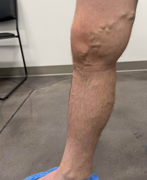 Before Image: Spider Vein Treatment - left-side
