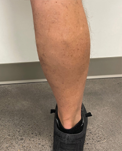 After Image: Spider Vein Treatment - back
