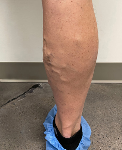 Before Image: Spider Vein Treatment - back