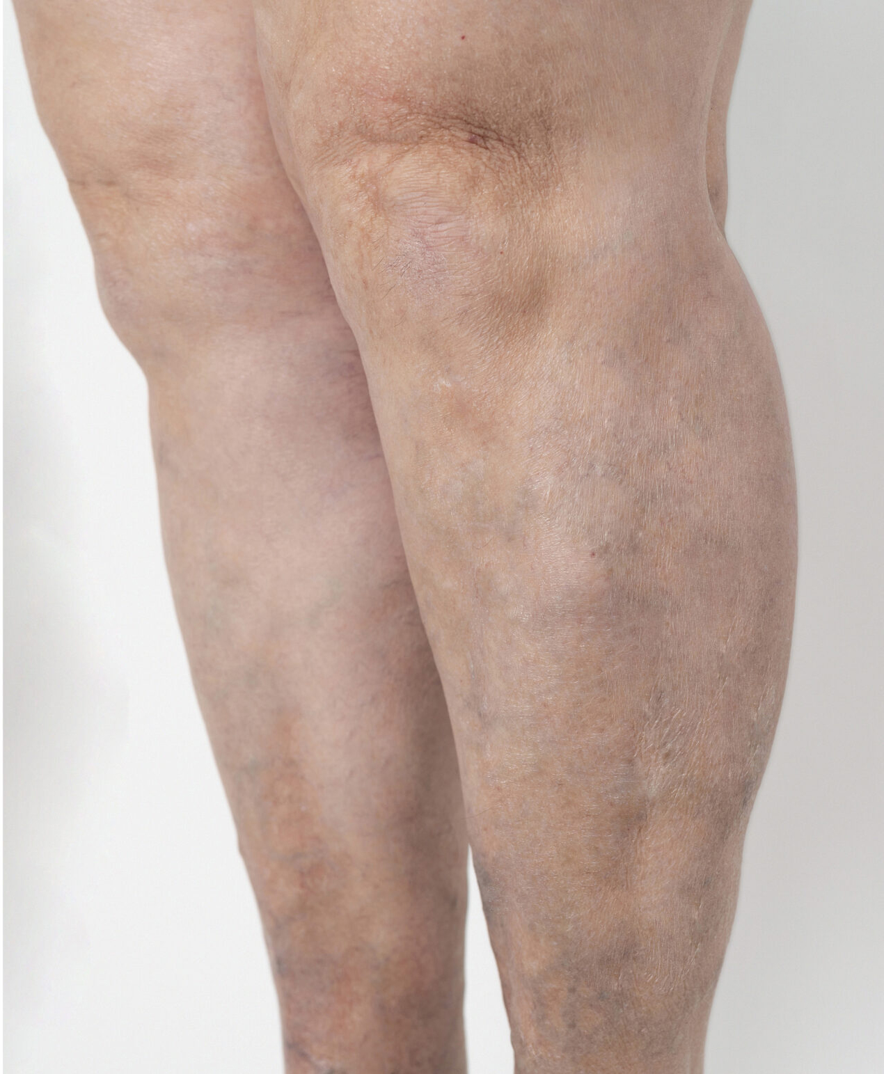 After Image: Varicose Vein Treatment - left-front-oblique