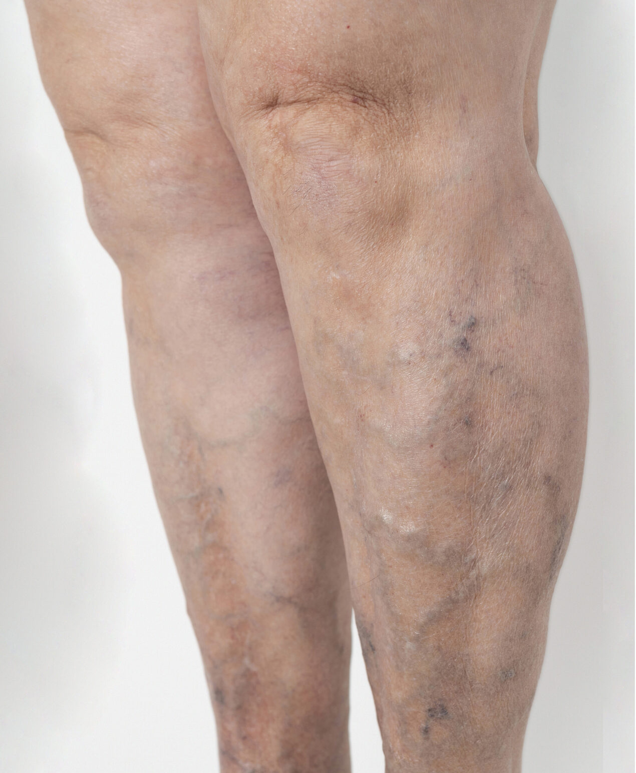 Before Image: Varicose Vein Treatment - left-front-oblique