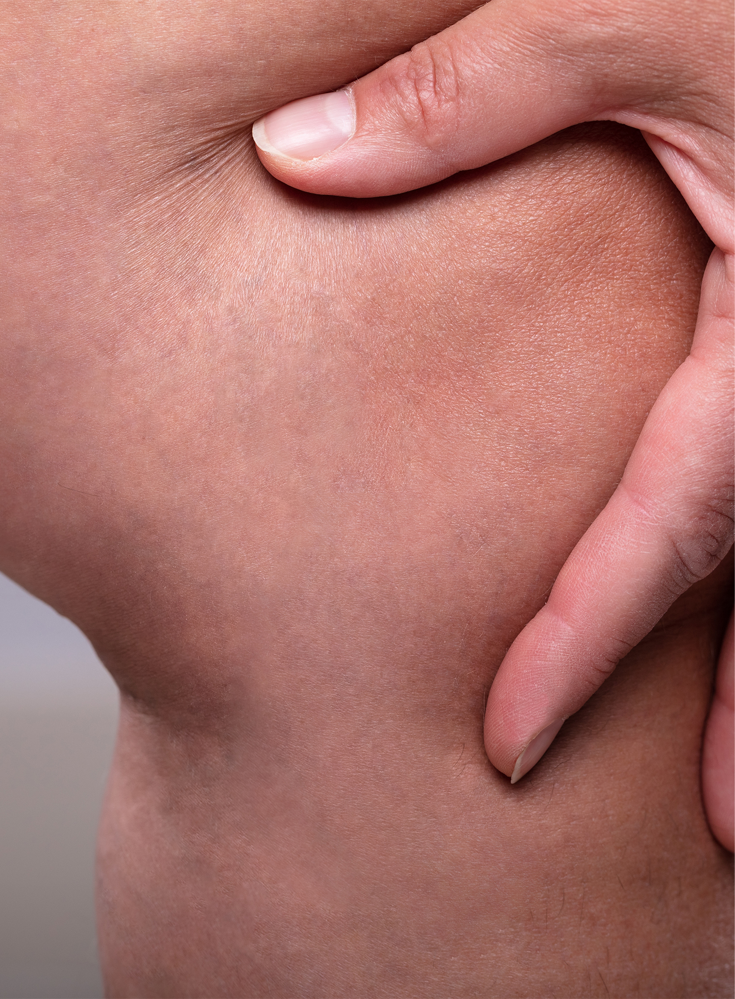 After Image: Spider Vein Treatment - right-side