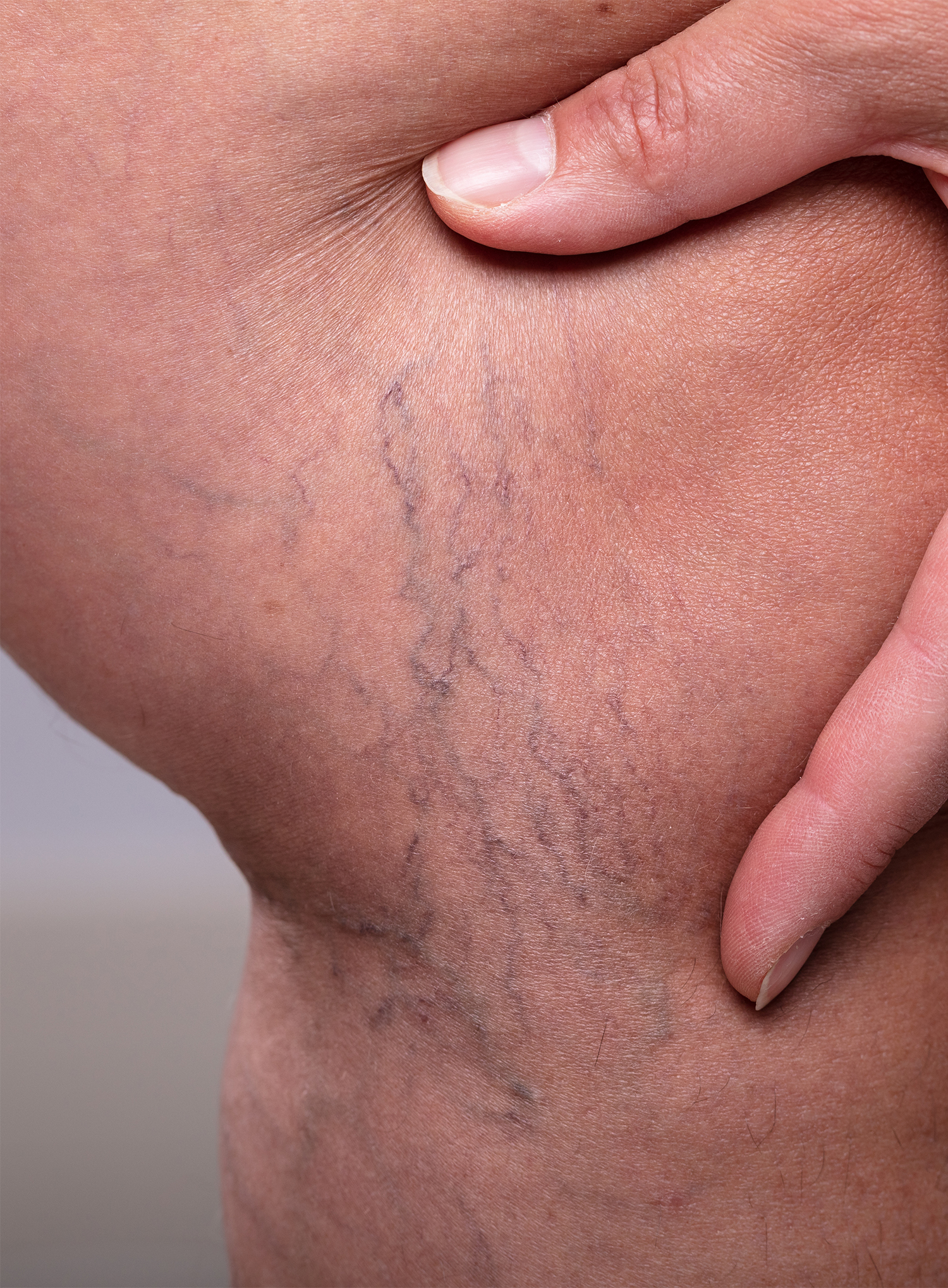 Before Image: Spider Vein Treatment - right-side