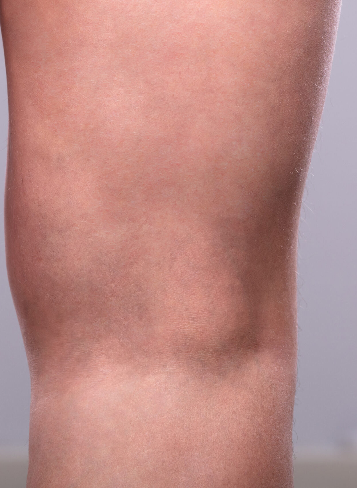 After Image: Spider Vein Treatment - back