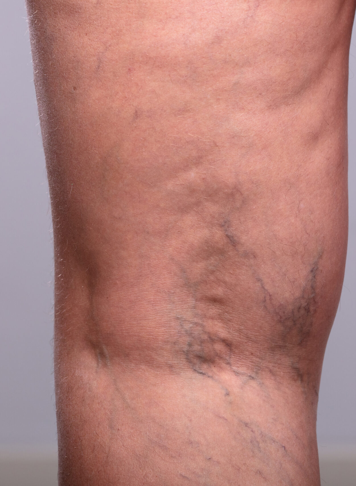 Before Image: Spider Vein Treatment - back