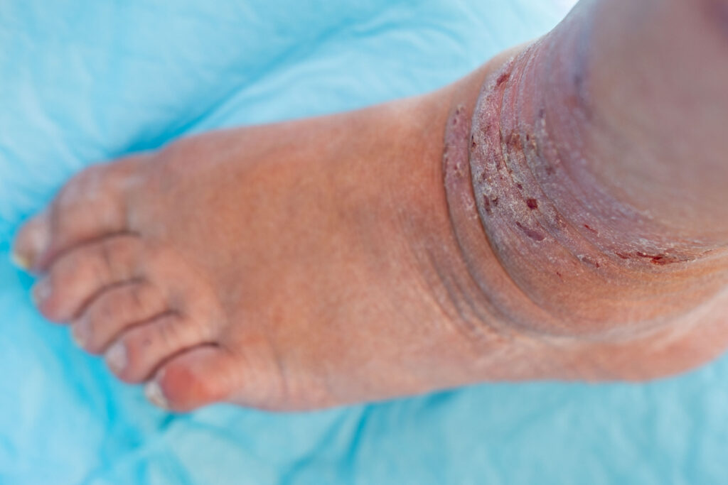 Close-up of a swollen ankle and foot with dry, irritated, discolored skin, illustrating skin changes that may be associated with vein disease. Close-up of a swollen ankle and foot with dry, irritated, discolored skin, illustrating skin changes that may be associated with vein disease.